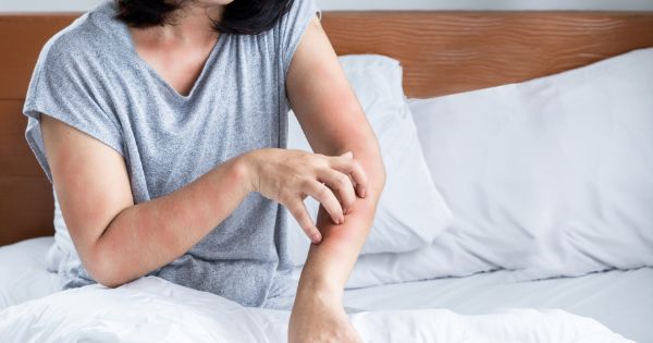 Signs of bedbug bites