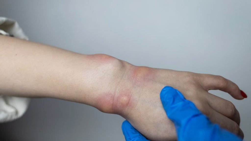 Health risk of mice bite